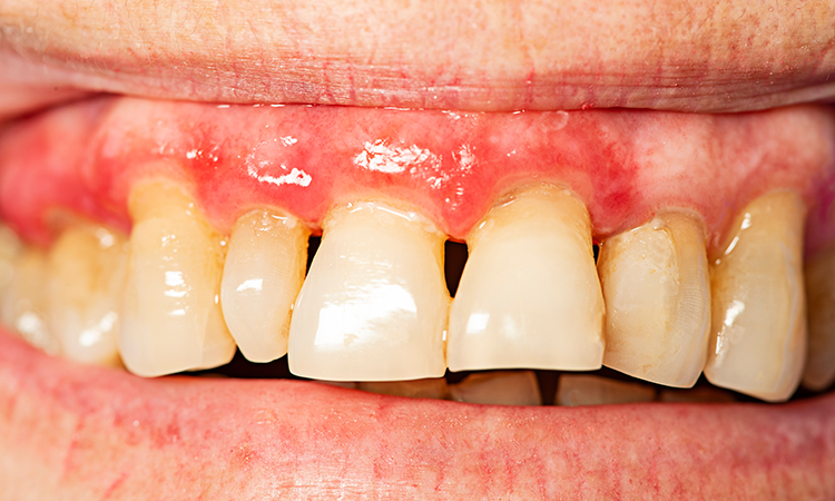 Parodontitis-periodontitis-Vera-Kuttelvaserova-AdobeStock_249499373