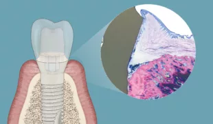 Durch die Kombination aus Soft-Tissue-Level-Design, spezialisierter Oberflächentopografie und Materialkomposition erzielt das zweiteilige Patent™ Implantat einen intimen Kontakt zwischen transmukosaler Oberfläche und Weichgewebe. Das kann Bakterien daran hindern, in die periimplantären Weich- und Hartgewebe einzudringen.