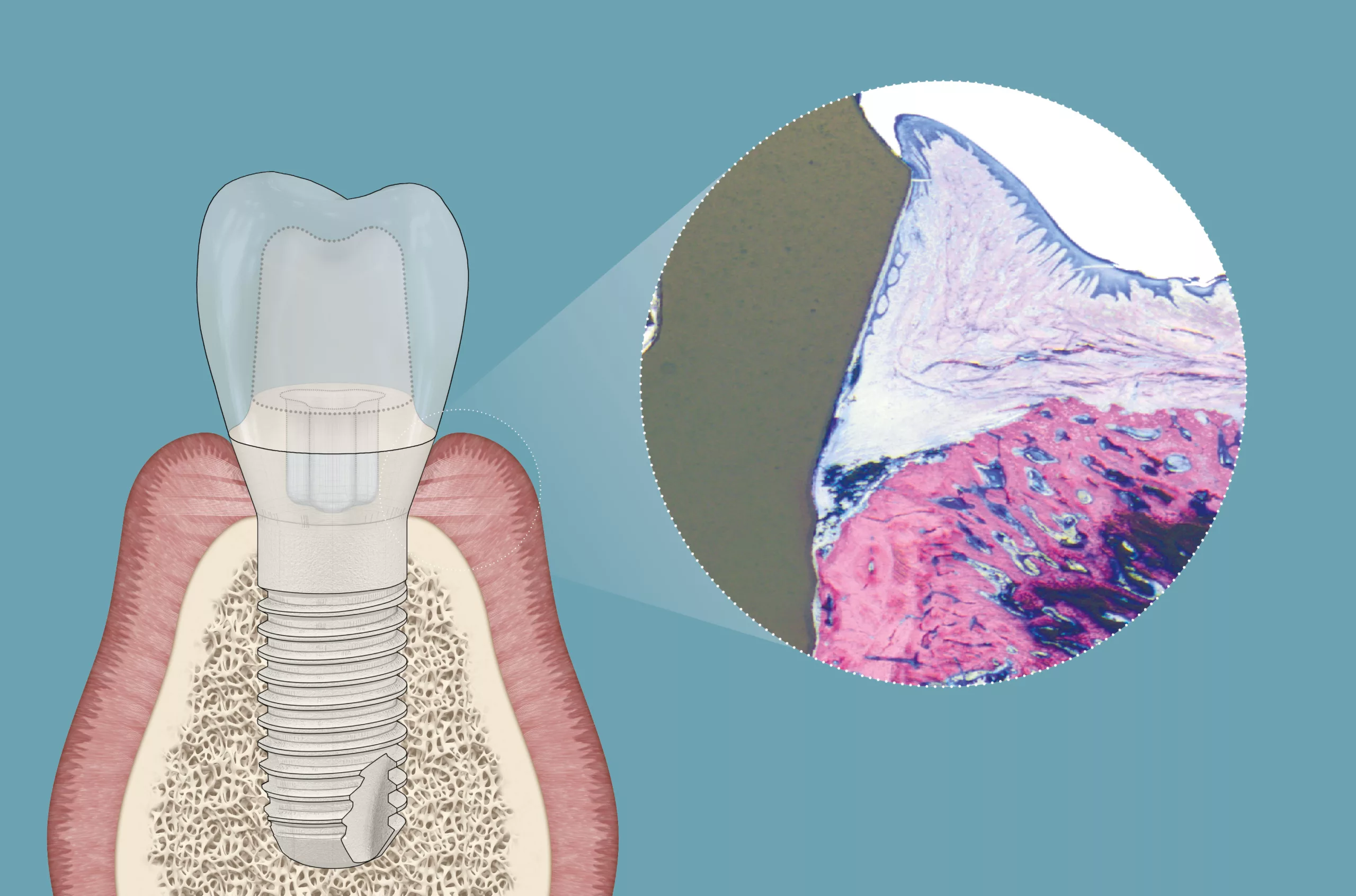 Durch die Kombination aus Soft-Tissue-Level-Design, spezialisierter Oberflächentopografie und Materialkomposition erzielt das zweiteilige Patent™ Implantat einen intimen Kontakt zwischen transmukosaler Oberfläche und Weichgewebe. Das kann Bakterien daran hindern, in die periimplantären Weich- und Hartgewebe einzudringen.