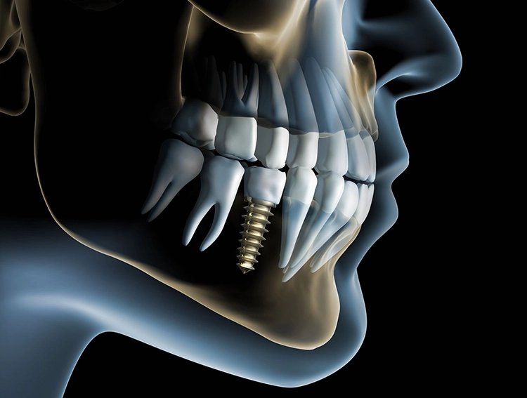 Allgemeine Implantologie_Fotolia_27078846_M[1]