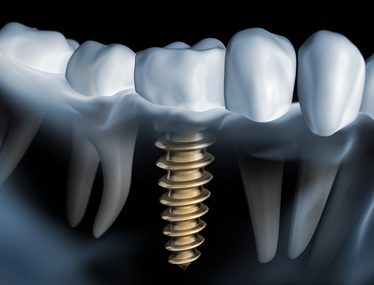 Festsitzende Implantatprothetik_Fotolia_27108857_L