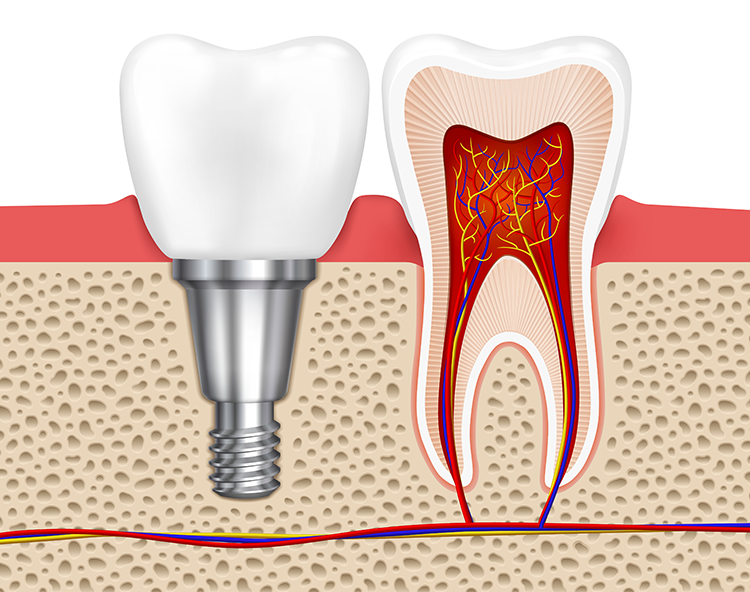 Periimplantitis