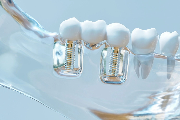 Implantatprothetik_iStock-1125898430