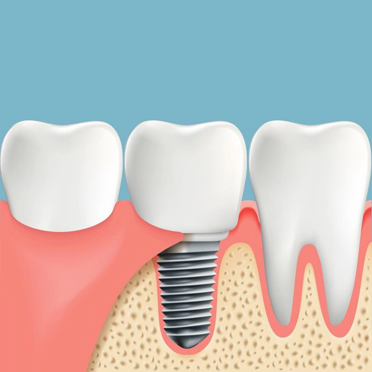 Osseointegration Periimplantitis_Fotolia_111301538_S