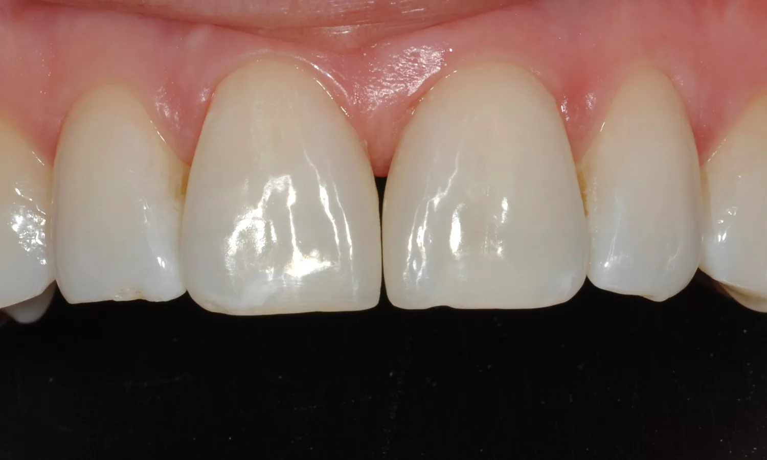 Diastema-Schluss mit direkt aufgetragenem Komposit anstelle von invasiveren Verfahren wie Keramik-Veneers. Behandlerin Prof. Dr. Diana Wolff