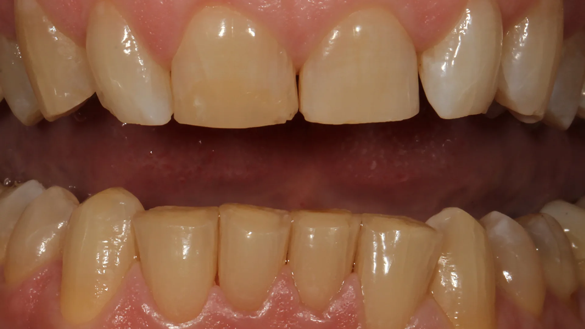 En-face-Bild eines 53-jährigen Patienten mit scharfkantigen, abradierten Eckzähnen.