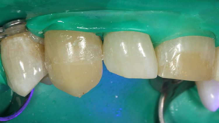 Aufbau in der Core-Farbe A3 unmittelbar nach Abnahme der
Stripkrone.