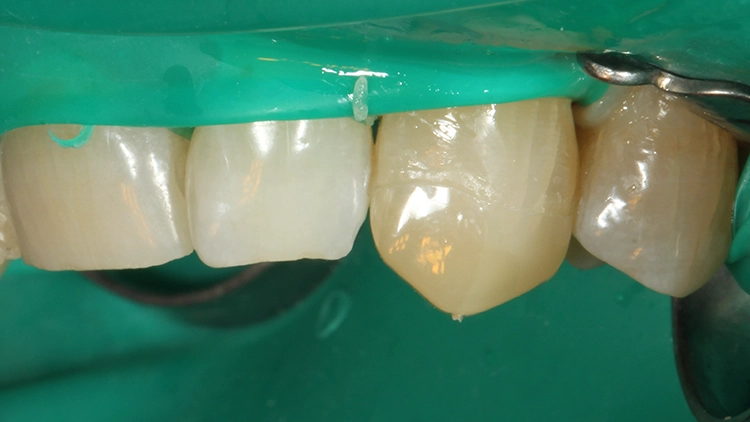 Aufgesetzte Stripkrone mit der Core-Farbe A3 (Stripkrone noch in
situ).