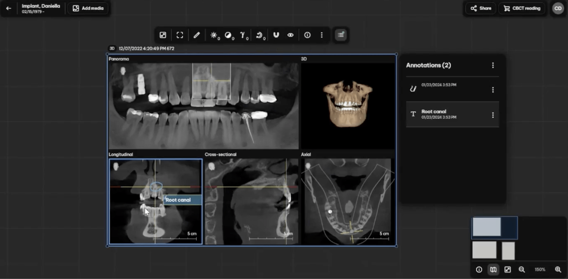 Erweitertes Annotationswerkzeug in DS Core: Neben 2D-Bildern können nun auch Freihand- und Textkommentare zu 3D-Röntgenbildern hinzugefügt werden.