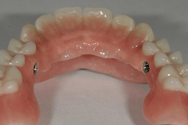 Abb. 100: … als auch im Oberkiefer zum Ausarbeiten und zur Politur entfernt.