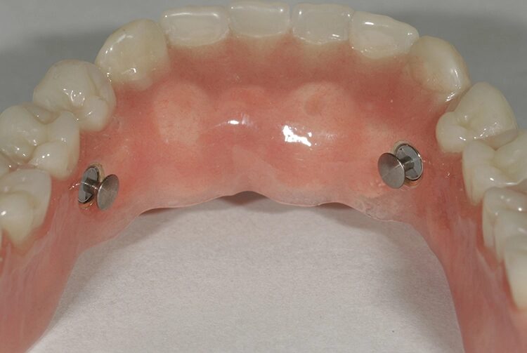 Abb. 101: Der eingebrachte Steckriegeleinsatz in der geöffneten, arretierten Anschlagstellung im Unterkiefer …