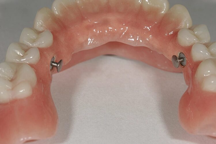 Abb. 102: ... und im Oberkiefer.