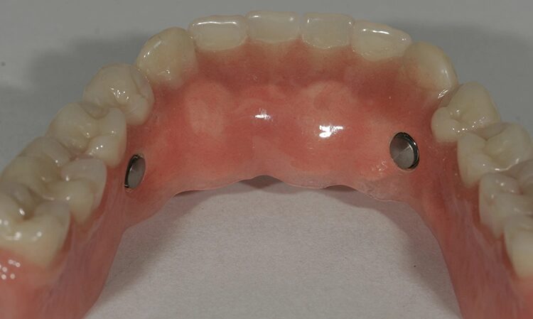 Abb. 103: Die arretierte Endposition im Unterkiefer …