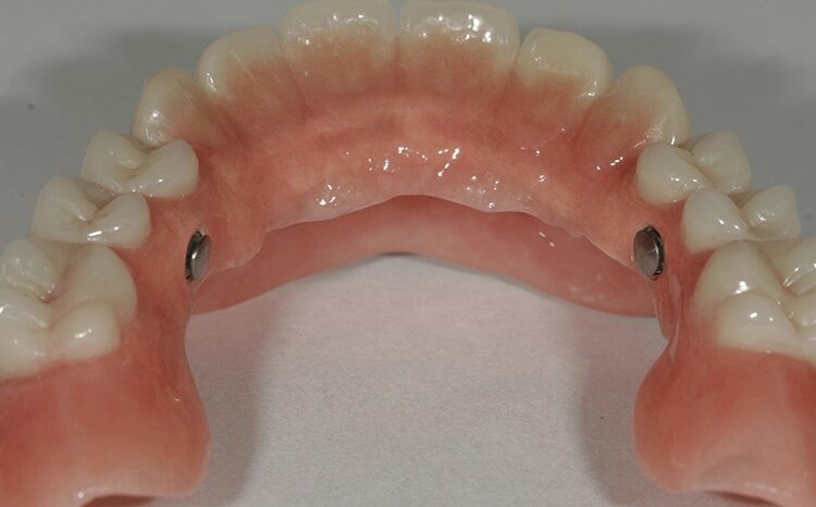 Abb. 104: … und im Oberkiefer.