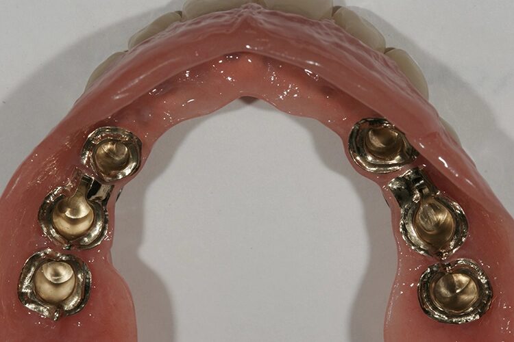 Abb. 106: Minimale Platzverhältnisse zwischen Stegstummel und Abutment 23/24.