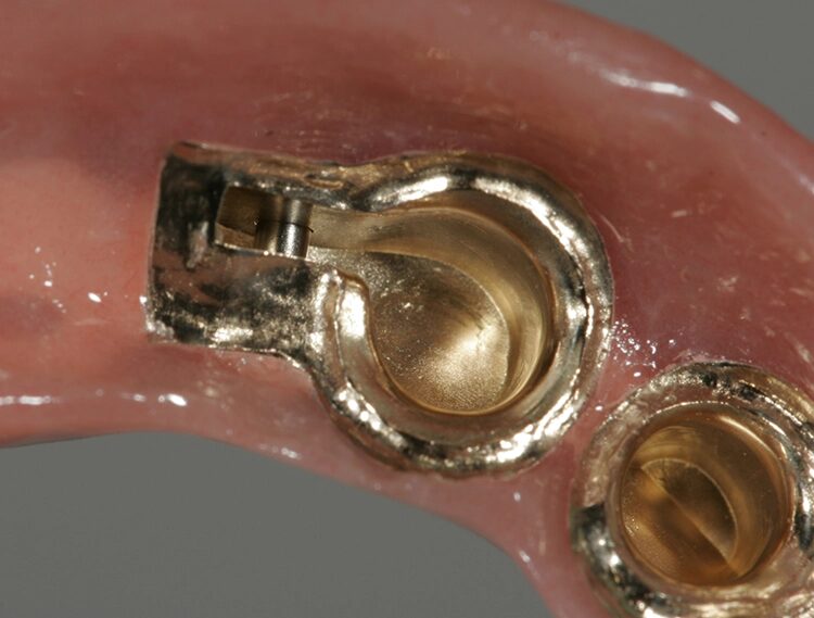 Abb. 107: Das Gegenlager bringt mehr Stabilität und entlastet das Funktionsteil.