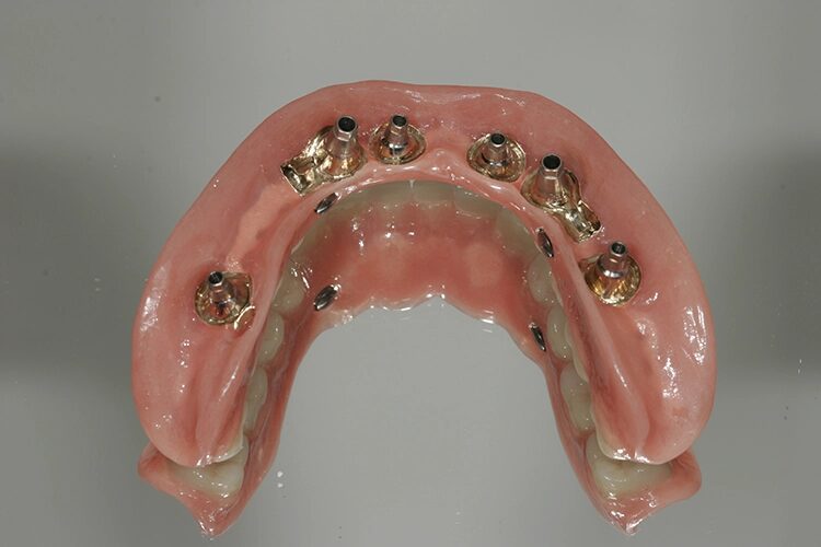 Abb. 109: Gesamtkonstruktion Unterkiefer …