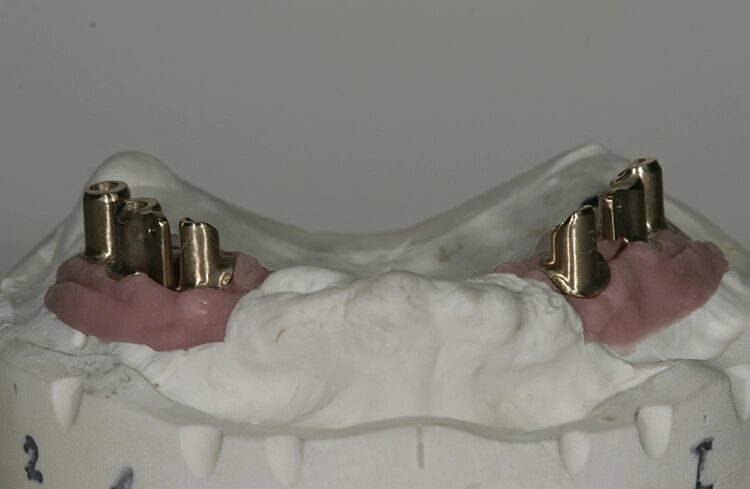 Abb. 111: Sämtliche Abutments im Oberkiefer …