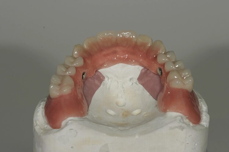 Abb. 113: Der Gaumenbereich ist weitgehend freigehalten.