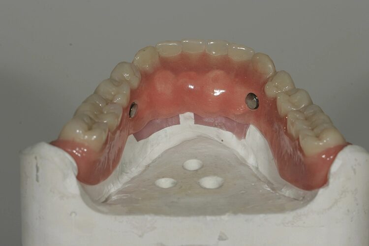 Abb. 114: Im Frontzahngebiet gibt es lingual stellenweise nur geringe Platzverhältnisse zur Tertiärkonstruktion.