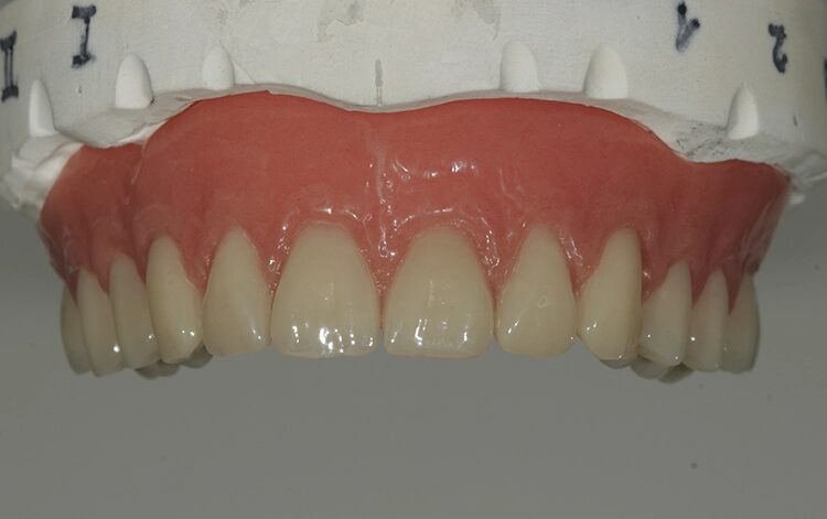 Abb. 115: Die Oberkieferfront nach Vorgabe: hell, clean und nahezu gleichmäßig.