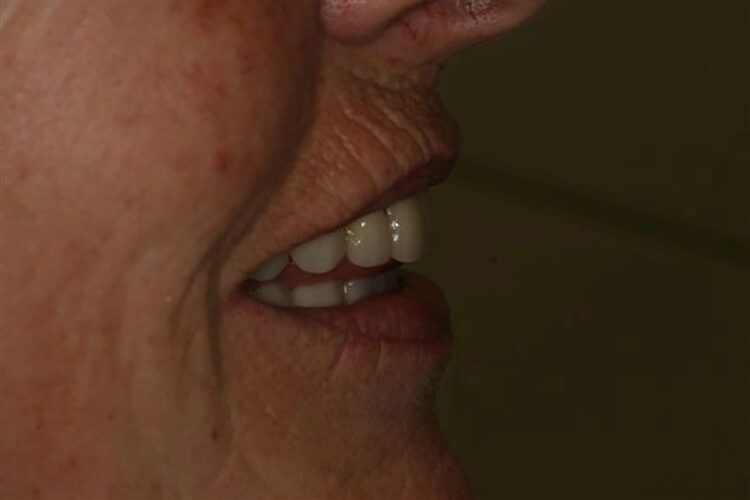 Abb. 120: Lippenfülle und Länge nach Vorstellung der Patientin.