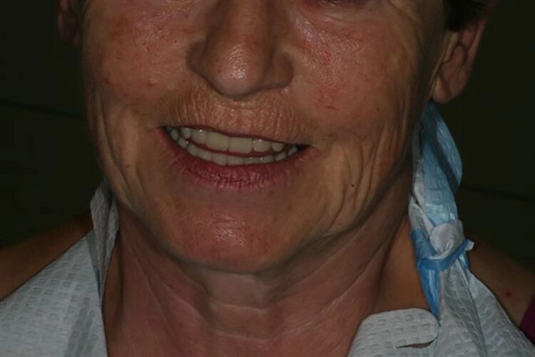 Abb. 120: Lippenfülle und Länge nach Vorstellung der Patientin.