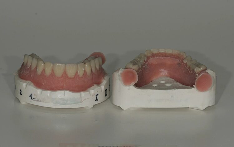 Abb. 97: Nach dem Entfernen der Vorwälle bereits ein sauberes Ergebnis.