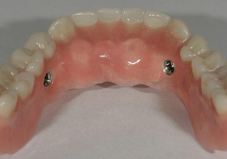 Abb. 99: Die Steckriegeleinsätze wurden zur Schonung sowohl im Unterkiefer …