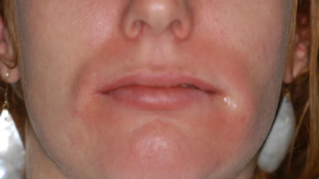 Abb. 1: Zuvor unbekannte Latexallergie: Zustand nach der Entfernung des Kofferdams.