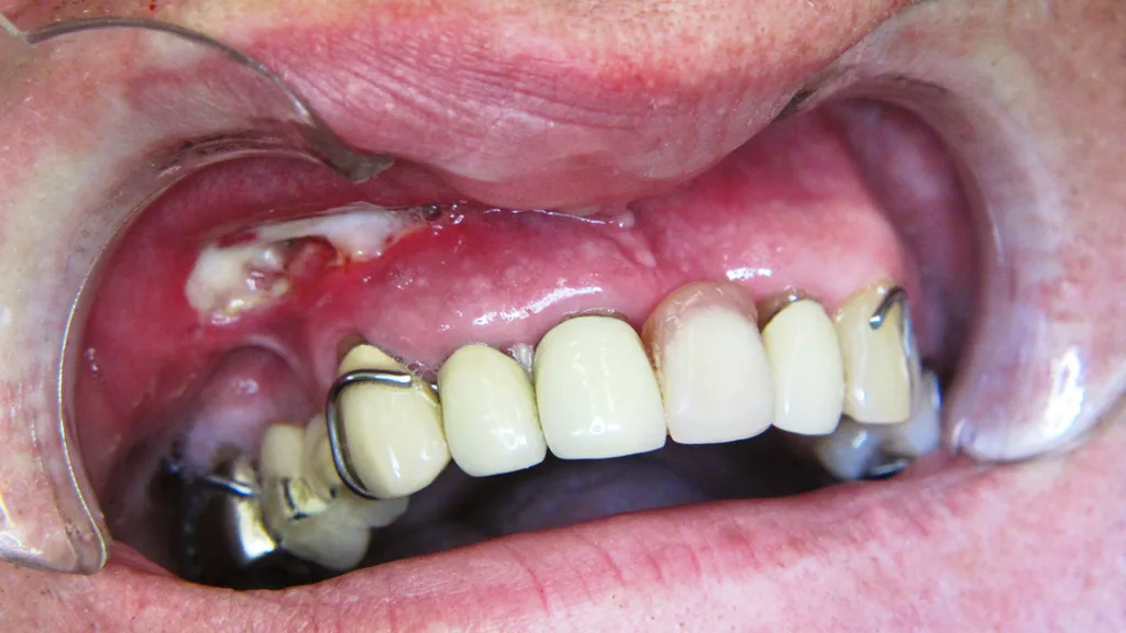 Abb. 2: Gewebenekrose nach apikaler Extrusion von Natriumhypochlorit während der Wurzelkanalbehandlung von Zahn 13.