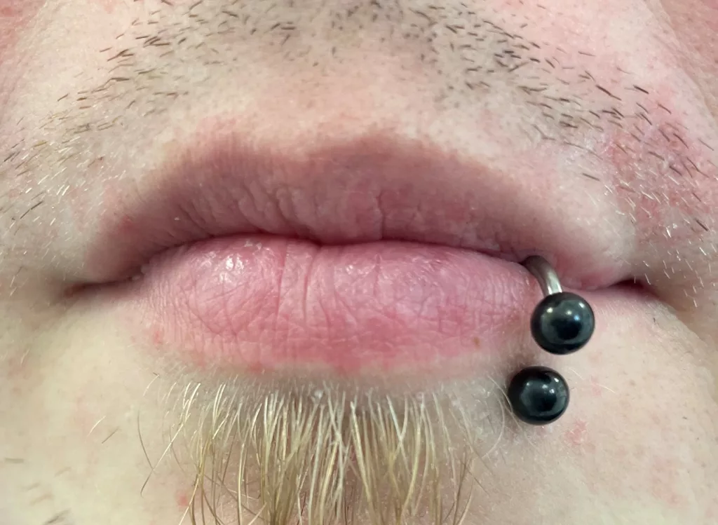 Abb. 2a: Extraorale Aufnahme und Panoramaschichtaufnahme eines 33-jährigen, multimorbiden Patienten mit einem lateralen Lippenpiercing. Der Patient geht keiner beruflichen Tätigkeit nach. Inwiefern das Piercing zur parodontalen Destruktion in regio 32/33 beigetragen hat, ist aufgrund der Verbreitung der generalisierten Parodontitis Stadium 3, Grad B unklar bzw. nicht sicher bestimmbar. Der Patient ist über mögliche schädigende Auswirkungen des Piercings auf die oralen Strukturen eingehend aufgeklärt und aufgefordert, das Piercing zu entfernen.
