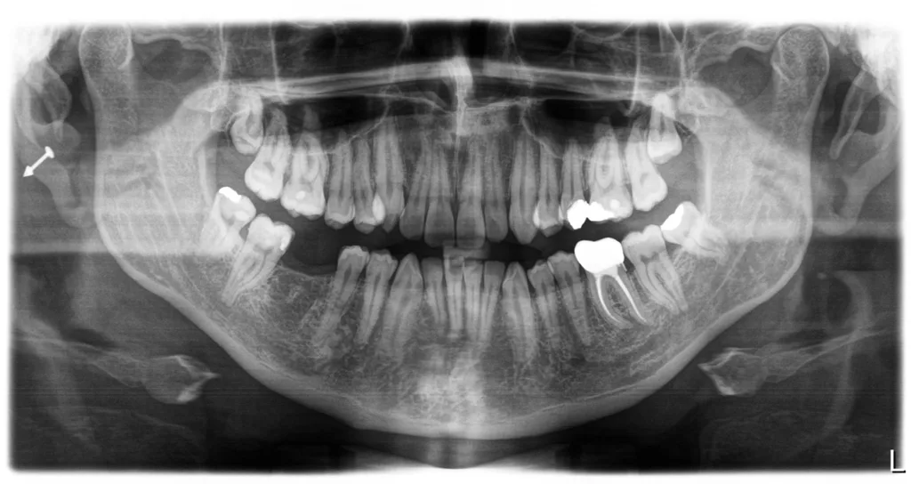 Abb. 2a–c: Extraorale Aufnahme und Panoramaschichtaufnahme eines 33-jährigen, multimorbiden Patienten mit einem lateralen Lippenpiercing. Der Patient geht keiner beruflichen Tätigkeit nach. Inwiefern das Piercing zur parodontalen Destruktion in regio 32/33 beigetragen hat, ist aufgrund der Verbreitung der generalisierten Parodontitis Stadium 3, Grad B unklar bzw. nicht sicher bestimmbar. Der Patient ist über mögliche schädigende Auswirkungen des Piercings auf die oralen Strukturen eingehend aufgeklärt und aufgefordert, das Piercing zu entfernen.