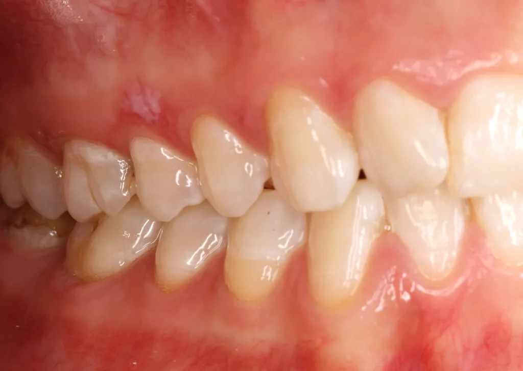 Abb. 4a: Klinische Dokumentation einer 30-jährigen Patientin. Die intraoralen Aufnahmen zeigten ein gepflegtes Gebiss. Eine Vorliebe für intraorale Accessoires ist durch den aufgeklebten Glitzerstein und ein Zungenpiercing sichtbar. Die fortgeschrittene parodontale Symptomatik an Zahn 41 wird erst durch eine gründliche parodontale Untersuchung deutlich. Es liegen hier lokal erhöhte Sondierungstiefen bis zu 7 mm und eine linguale gingivale Rezession vor. Die Patientin wurde über die Problematik aufgeklärt und instruiert, das Piercing zu entfernen. Die systematische parodontale Therapie wurde eingeleitet.