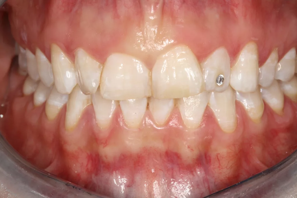 Abb. 4b: Klinische Dokumentation einer 30-jährigen Patientin. Die intraoralen Aufnahmen zeigten ein gepflegtes Gebiss. Eine Vorliebe für intraorale Accessoires ist durch den aufgeklebten Glitzerstein und ein Zungenpiercing sichtbar. Die fortgeschrittene parodontale Symptomatik an Zahn 41 wird erst durch eine gründliche parodontale Untersuchung deutlich. Es liegen hier lokal erhöhte Sondierungstiefen bis zu 7 mm und eine linguale gingivale Rezession vor. Die Patientin wurde über die Problematik aufgeklärt und instruiert, das Piercing zu entfernen. Die systematische parodontale Therapie wurde eingeleitet.