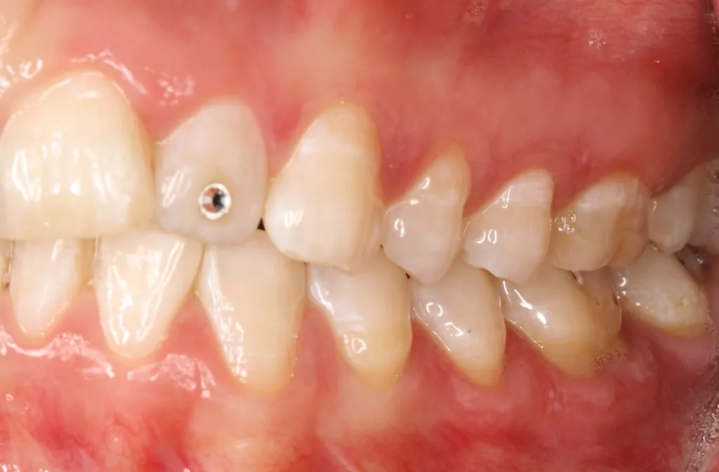 Abb. 4c: Klinische Dokumentation einer 30-jährigen Patientin. Die intraoralen Aufnahmen zeigten ein gepflegtes Gebiss. Eine Vorliebe für intraorale Accessoires ist durch den aufgeklebten Glitzerstein und ein Zungenpiercing sichtbar. Die fortgeschrittene parodontale Symptomatik an Zahn 41 wird erst durch eine gründliche parodontale Untersuchung deutlich. Es liegen hier lokal erhöhte Sondierungstiefen bis zu 7 mm und eine linguale gingivale Rezession vor. Die Patientin wurde über die Problematik aufgeklärt und instruiert, das Piercing zu entfernen. Die systematische parodontale Therapie wurde eingeleitet.