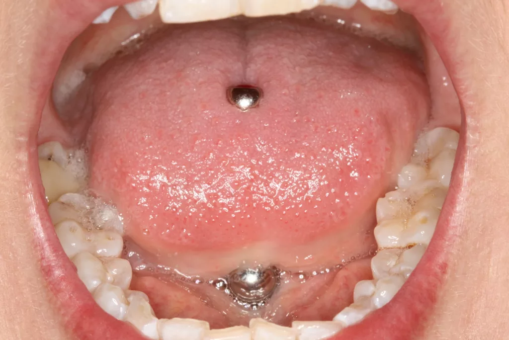 Abb. 4d: Klinische Dokumentation einer 30-jährigen Patientin. Die intraoralen Aufnahmen zeigten ein gepflegtes Gebiss. Eine Vorliebe für intraorale Accessoires ist durch den aufgeklebten Glitzerstein und ein Zungenpiercing sichtbar. Die fortgeschrittene parodontale Symptomatik an Zahn 41 wird erst durch eine gründliche parodontale Untersuchung deutlich. Es liegen hier lokal erhöhte Sondierungstiefen bis zu 7 mm und eine linguale gingivale Rezession vor. Die Patientin wurde über die Problematik aufgeklärt und instruiert, das Piercing zu entfernen. Die systematische parodontale Therapie wurde eingeleitet.