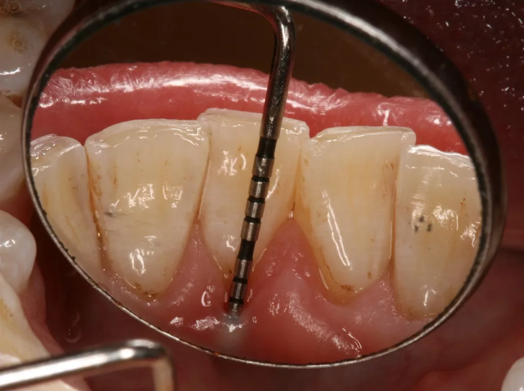Abb. 4e: Klinische Dokumentation einer 30-jährigen Patientin. Die intraoralen Aufnahmen zeigten ein gepflegtes Gebiss. Eine Vorliebe für intraorale Accessoires ist durch den aufgeklebten Glitzerstein und ein Zungenpiercing sichtbar. Die fortgeschrittene parodontale Symptomatik an Zahn 41 wird erst durch eine gründliche parodontale Untersuchung deutlich. Es liegen hier lokal erhöhte Sondierungstiefen bis zu 7 mm und eine linguale gingivale Rezession vor. Die Patientin wurde über die Problematik aufgeklärt und instruiert, das Piercing zu entfernen. Die systematische parodontale Therapie wurde eingeleitet.