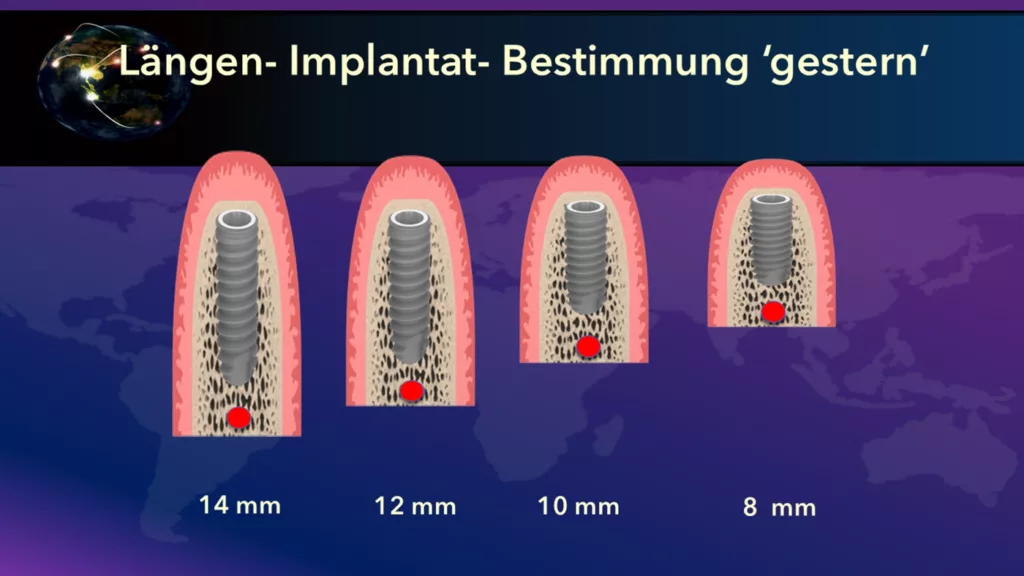 Abb. 1: In der Vergangenheit wurden oftmals möglichst lange Implantate mithilfe eines OPTGs geplant: Bei einem Platzangebot von z.B. 16 mm wurden 14 mm lange, bei 10 mm entsprechend 8 mm lange Implantate inseriert.