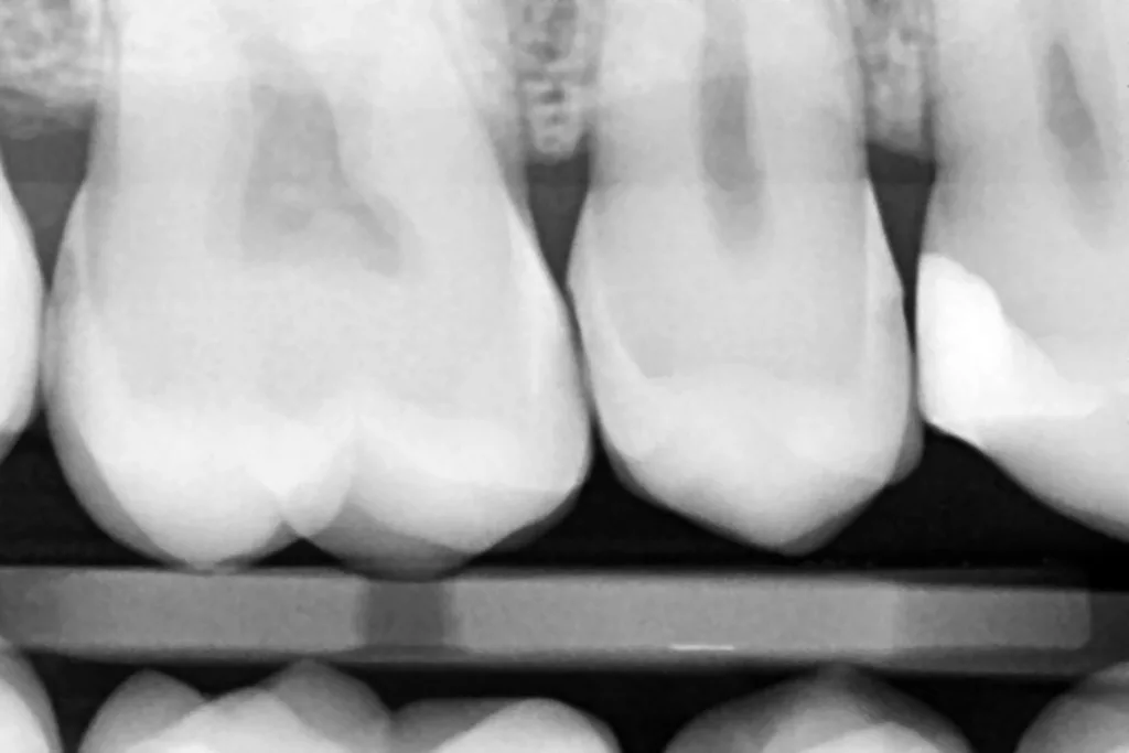 Abb. 12: Bissflügelröntgenaufnahmen: Die Bulkfill- Restauration zeigt sich randdicht, anatomisch korrekt geformt und ausreichend röntgenopak.