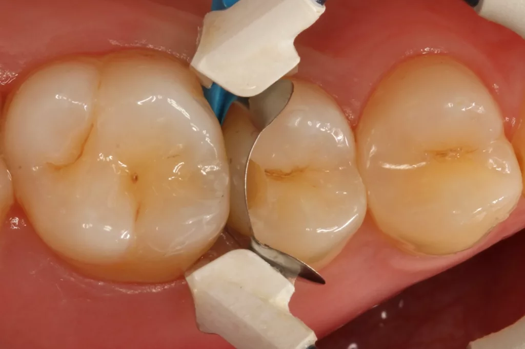Abb. 13: Versorgung des Defektes an Zahn 15. Die Dentinkaries war im Bissflügelbild (Abb. 12) erkennbar.