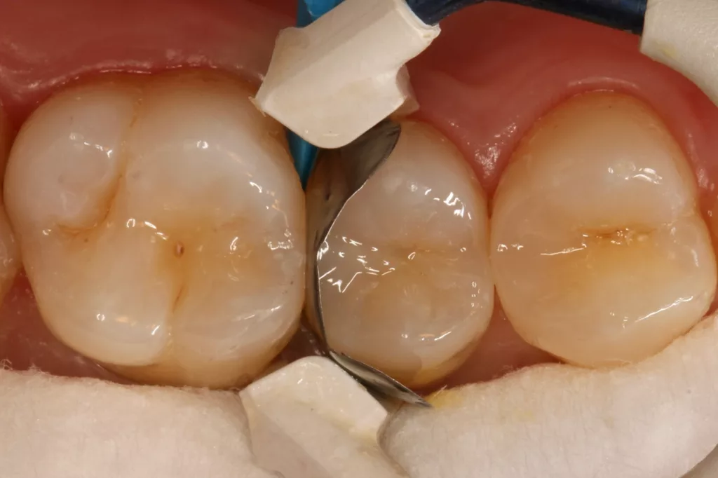 Abb. 14: Auffüllen des Defektes mit dem standfesten Bulkflow-Material.