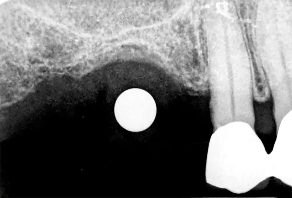 Abb. 2: Zur Bestimmung des Platzangebotes bediente man sich auch Bleikugeln mit einem Durchmesser von 5 mm, die mithilfe eines zähfließenden Bissregistrats oder einer direkt über dem OP-Gebiet angebrachten Tiefziehfolie fixiert wurden.