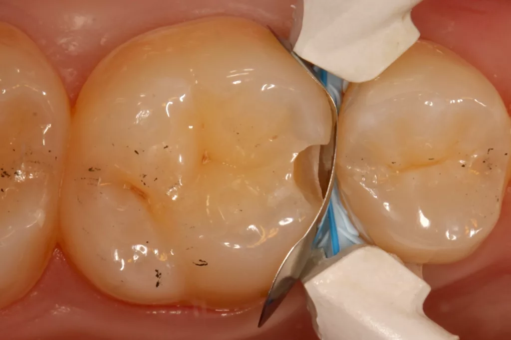Abb. 29: Approximaldefekt mesial an dem Zahn 26 mit bereits erfolgter Einschalung.