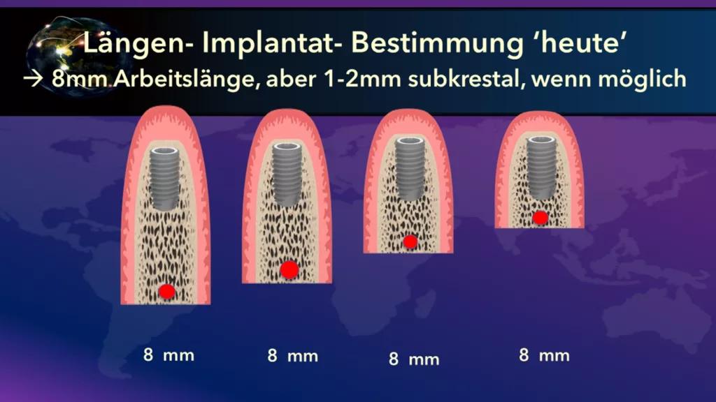 Abb. 3: Unabhängig von der zur Verfügung stehenden Restknochenhöhe (20 oder 10 mm) sind heute Implantate mit 8 mm (oder gar nur 6 mm) Länge als Standard wissenschaftlich längst akzeptiert und zeigen bei einigen Implantatsystemen gleichgute Langzeitstudien-Ergebnisse wie längere.