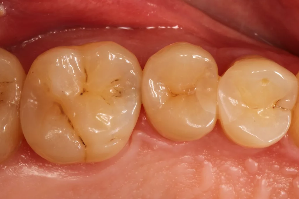 Abb. 33: Approximalläsion mesial an Zahn 26.
