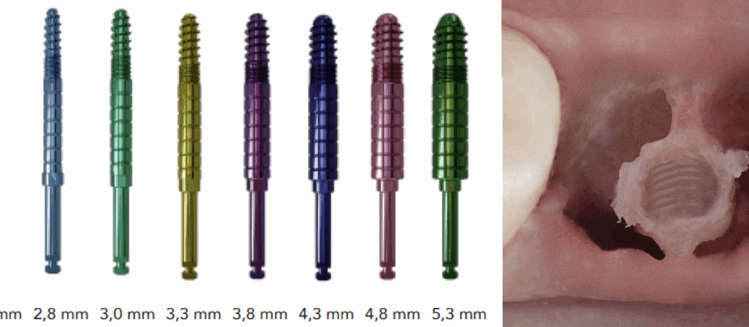 Die Champions-Implants Condenser mit WS-(Winkelstück-)Anschluss sind in aufsteigenden Durchmessern verfügbar. Dank ihrer ruhigen und hebelfreien Arbeitsweise ist selbst bei schmalen Bifurkationen eine optimale Aufbereitung der Implantatkavität leicht durchführbar.