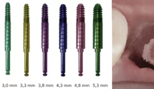 Die Champions-Implants Condenser mit WS-(Winkelstück-)Anschluss sind in aufsteigenden Durchmessern verfügbar. Dank ihrer ruhigen und hebelfreien Arbeitsweise ist selbst bei schmalen Bifurkationen eine optimale Aufbereitung der Implantatkavität leicht durchführbar.