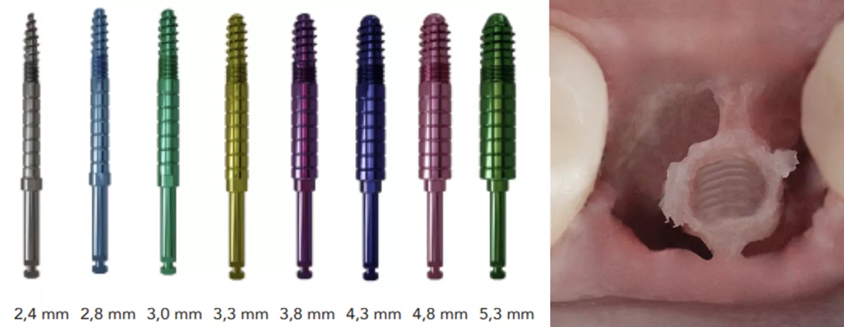 Die Champions-Implants Condenser mit WS-(Winkelstück-)Anschluss sind in aufsteigenden Durchmessern verfügbar. Dank ihrer ruhigen und hebelfreien Arbeitsweise ist selbst bei schmalen Bifurkationen eine optimale Aufbereitung der Implantatkavität leicht durchführbar.