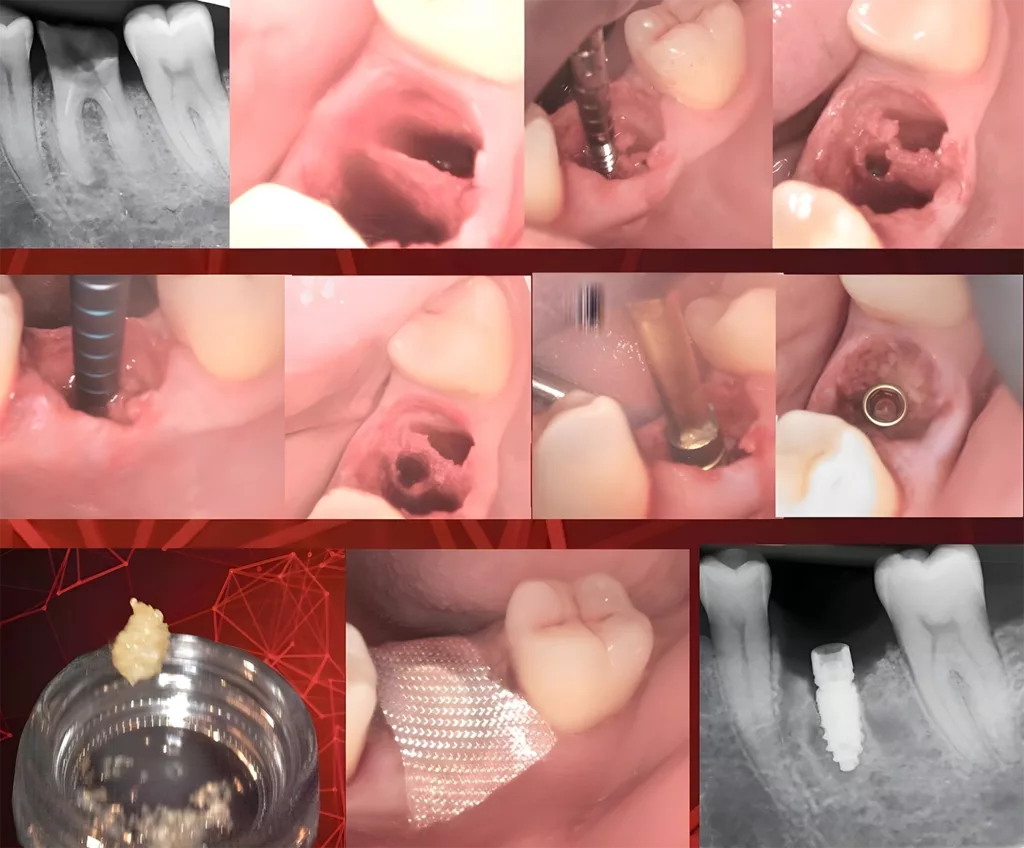 Abb. 2: Das Champions (R)Evolution Implantat wird mit bakteriendichtem Innenkonus mit integriertem Hexadapter und Abutment-Halteschraube inseriert.